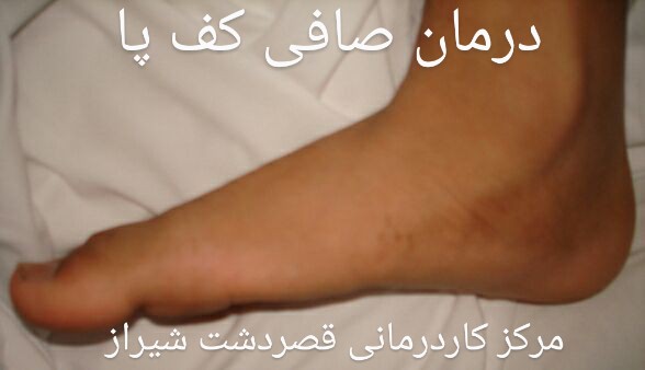 درمان صافی کف پا شیراز_مرکز کاردرمانی شیراز