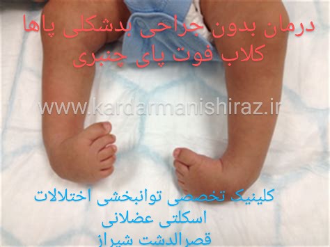 کاردرمانی پای چنبری کلاب فوت در شیراز،درمان بدون جراحی بدشکلی پاها در شیراز