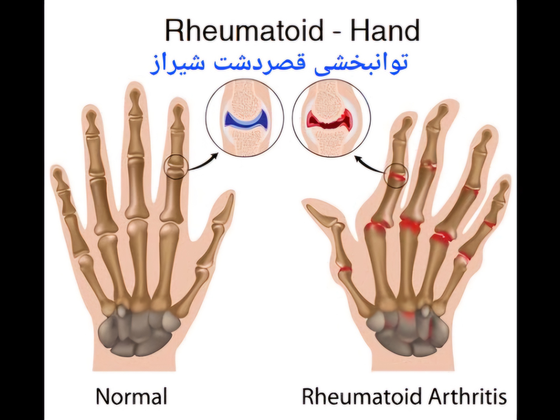 درمان تخصصی آرتروز دست با کاردرمانی /کلینیک قصردشت شیراز
