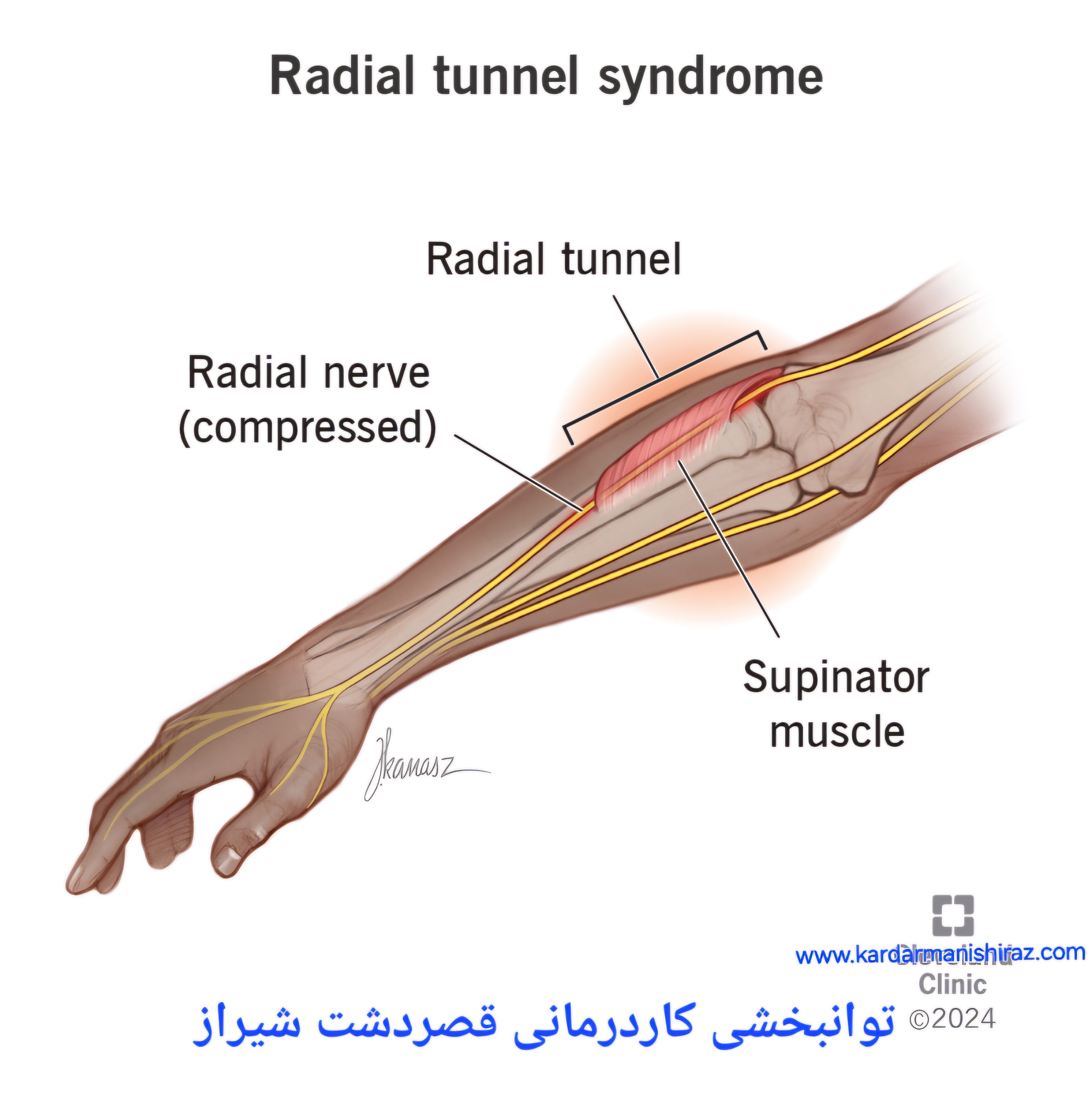 درمان تخصصی سندرم تونل رادیال شیراز_توانبخشی قصردشت