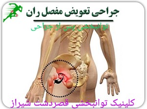 کاردرمانی پس از جراحی مفصل ران  در شیراز ،توانبخشی
