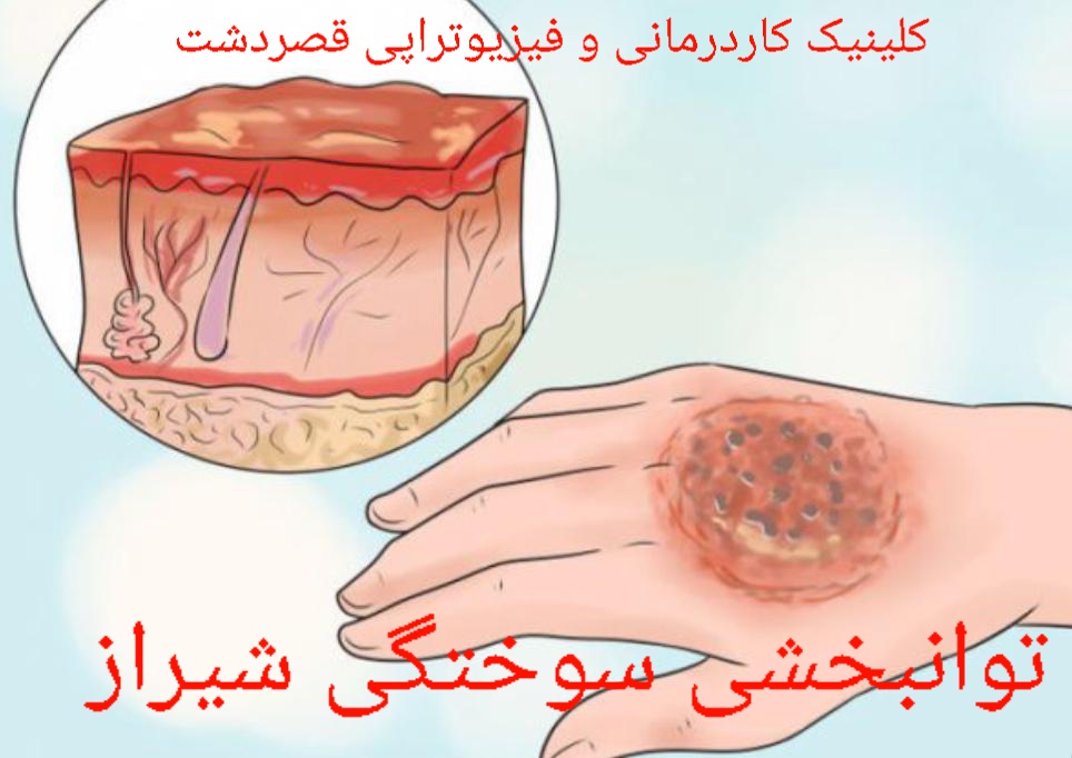 کاردرمانی شیراز و توانبخشی جراحت و سوختگی و زخم شیراز
