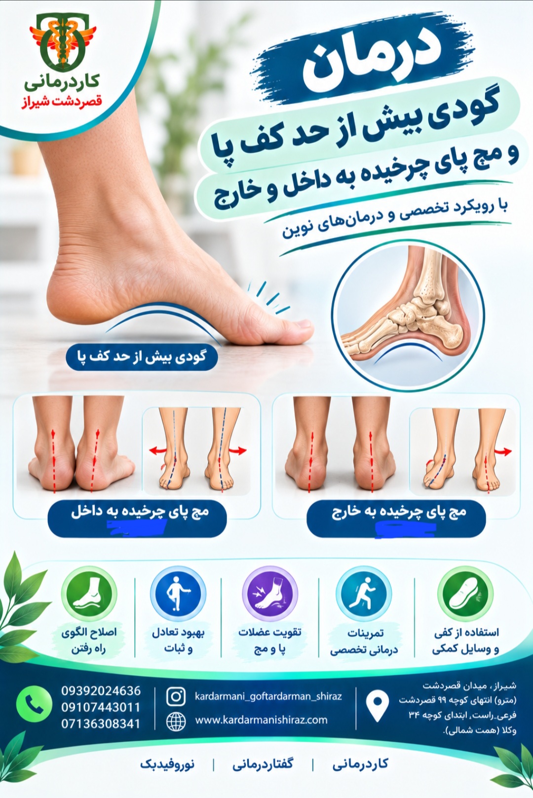 درمان گودی بیش از حد کف پا و اصلاح  مچ پای چرخیده به داخل و خارج با کاردرمانی شیراز