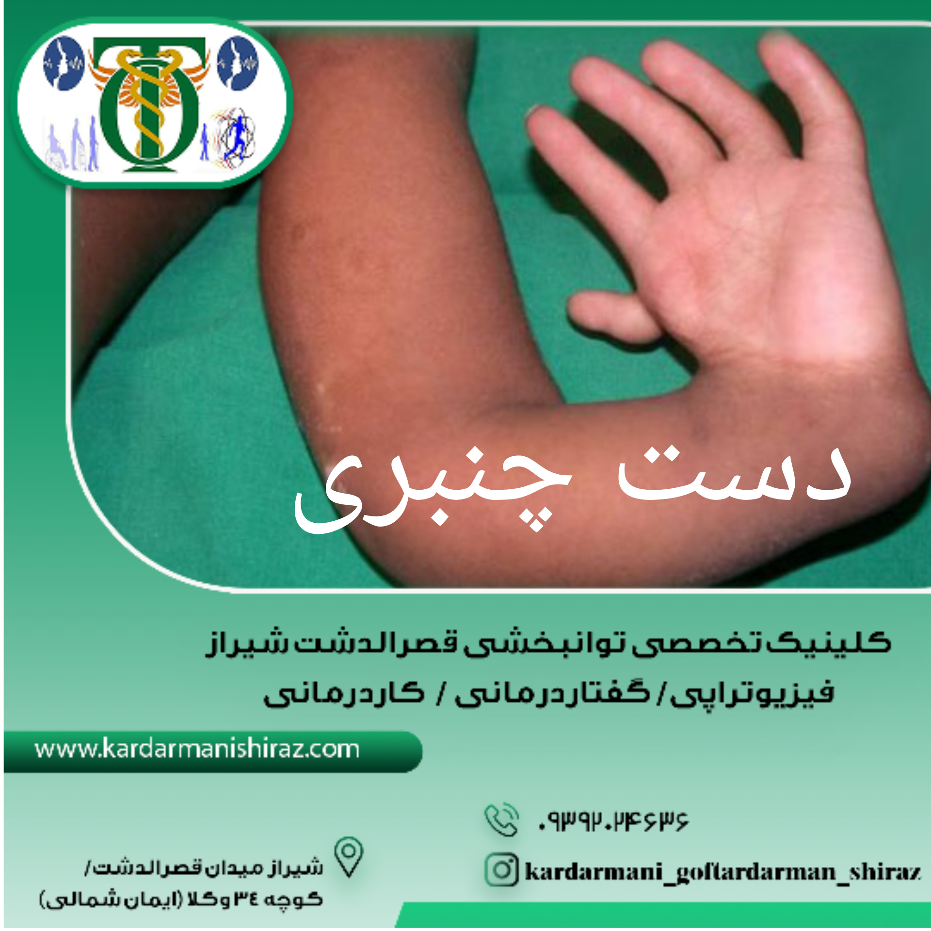 دست چنبری درکودکان_توانبخشی پس از جراحی شیراز